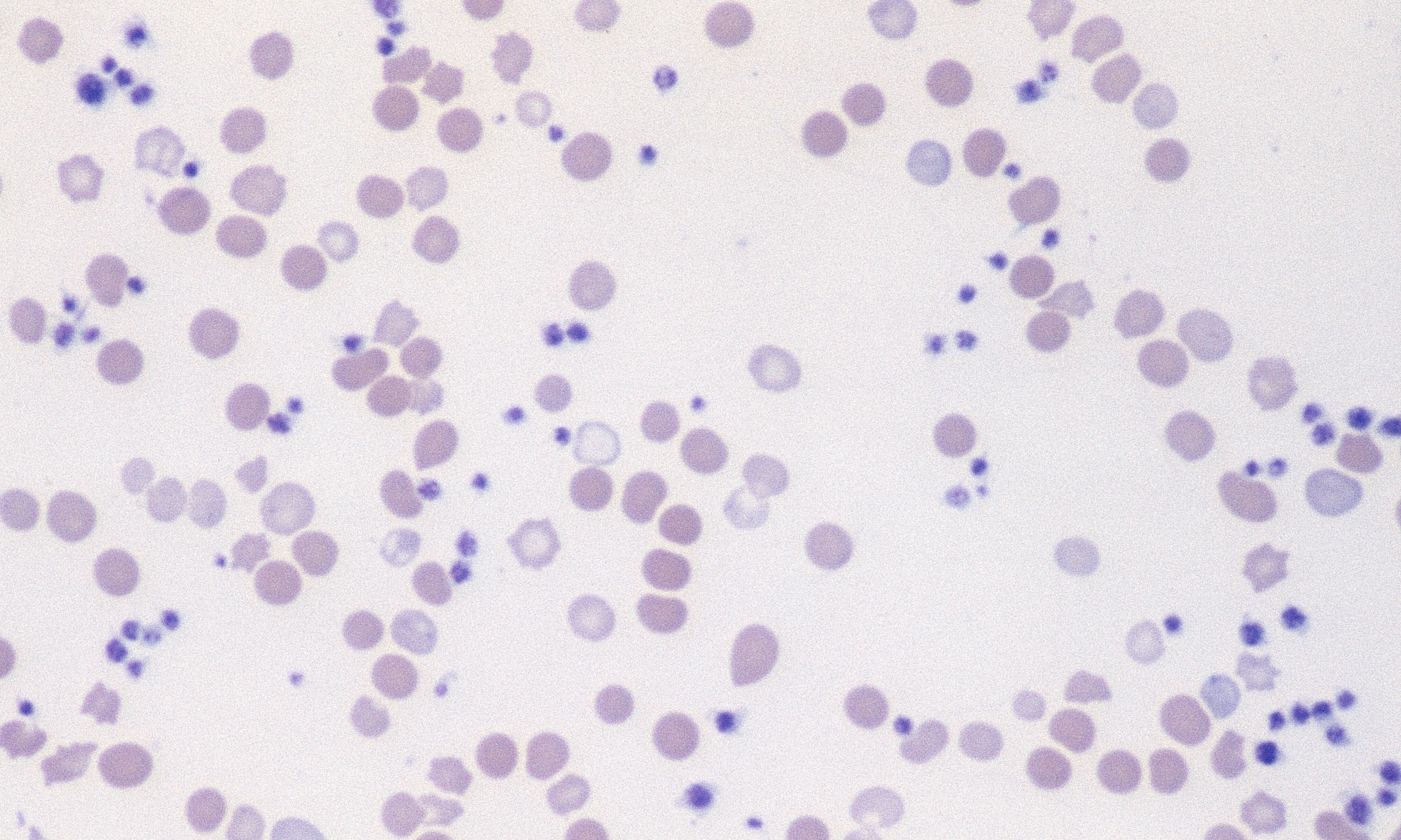 Platelets 12 (Canine 5 - Iron Deficiency) - Thrombocytosis