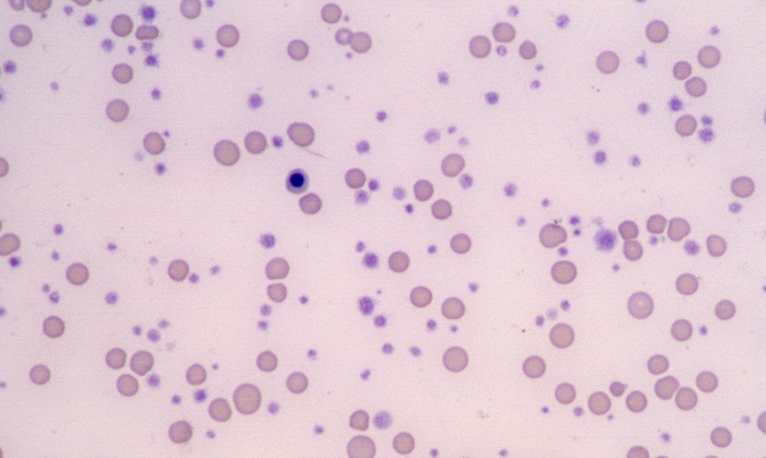 Platelets 13 (Feline 4 - Megakaryocytic Leukemia) - Thrombocytosis